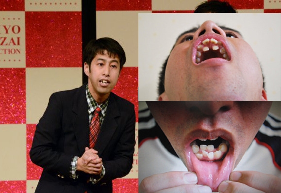 日本人たち歯牙状態 