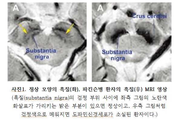 정상 모양의 흑질(좌), 파킨슨병 환자의 흑질(우) MRI 영상