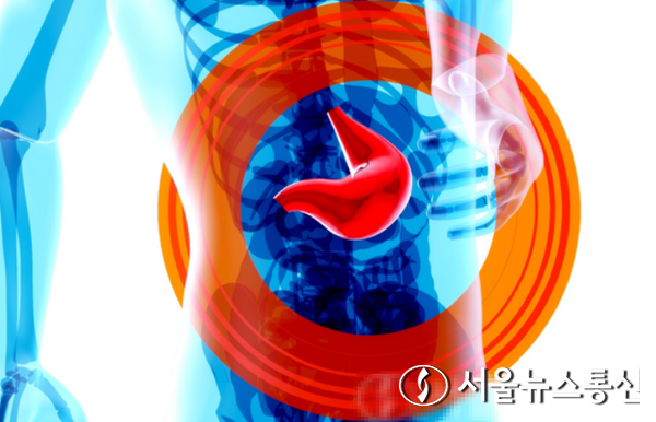 아주대병원 종양혈액내과 이현우 교수팀(김태환·안미선 교수)은 건강보험심사평가원에 등록되어 있는 빅데이터를 이용해, 위암 환자 2만 여 명의 위암 수술 후 보조항암화학요법의 치료기간에 따른 예후를 분석했다. (위장, 위암) / 사진 = 서울뉴스통신 DB