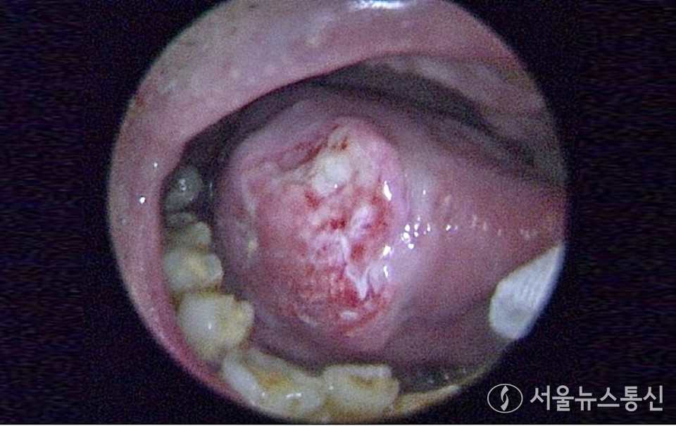 23일 의료계에 따르면 암은 젊은 연령층에서도 신규 환자가 꾸준히 증가하고 있다. 2021년 신규 설암 환자 중 20~30대가 80명으로 8%를 차지했다. (2024.07.22) / 사진 = 한림대동탄성심병원 제공
