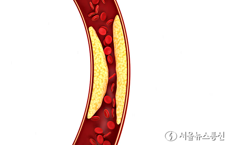 겨울철에는 기온이 낮아 혈관이 수축하고 혈액순환이 원활하지 않아 급성 심근경색 등 심혈관질환 환자가 증가한다. 최근에는 인구 고령화로 심장에 피를 공급하는 관상동맥이 죽종에 의해 막히는 죽상동맥경화증 환자가 매년 꾸준히 증가하고 있어 주의가 요구된다. (2025.02.03) / 이미지 = 게티이미지뱅크 제공