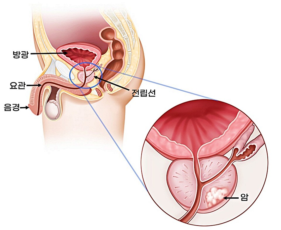 전립선암. / 이미지 = 서울아산병원 제공