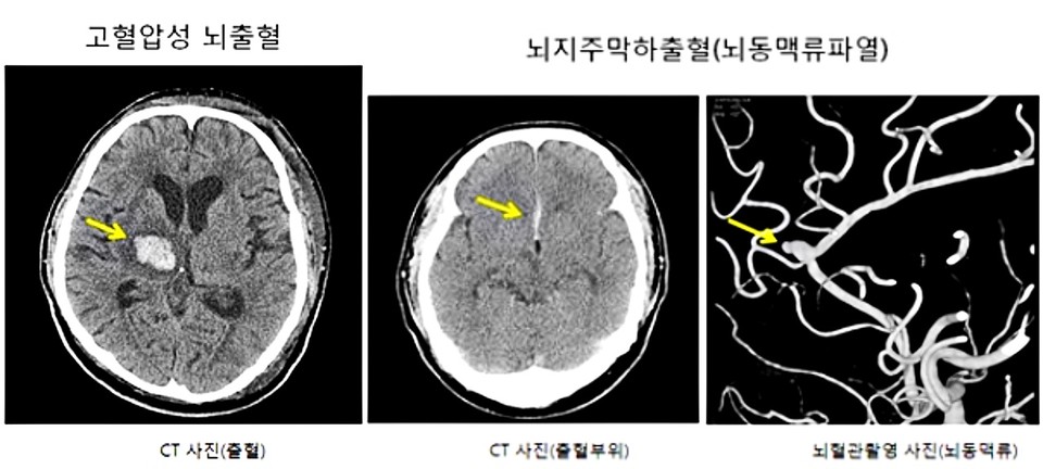 왼쪽부터 고혈압성 뇌출혈과 뇌지주막하출혈(뇌동맥류파열). / 사진 = 국민건강보험 일산병원 제공
