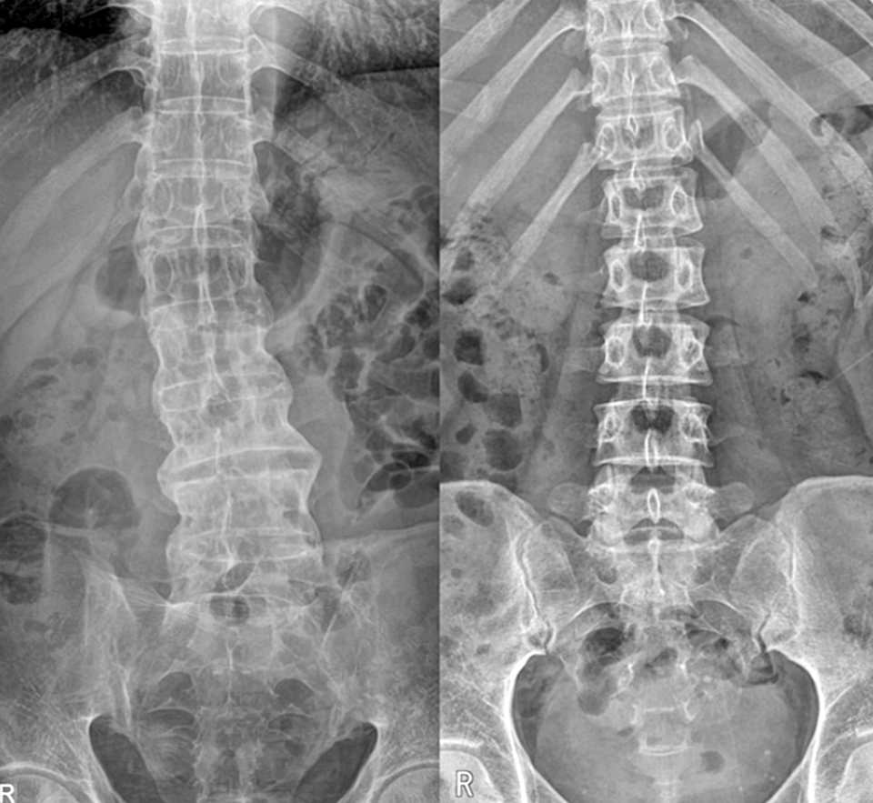 강직성척추염(왼쪽)과 정상 척추(오른쪽). 관절 없이 하나의 긴 뼈처럼 이어진 모습을 보인다. / 사진 = 가톨릭대학교 인천성모병원 제공