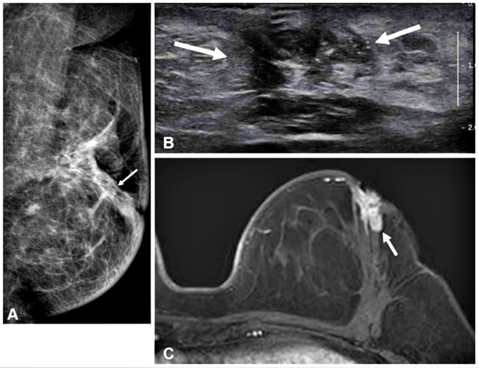 수술 후 같은 측 유방 내 재발이 발생한 젊은 유방암 환자의 검사 결과. / 사진 = 서울대병원 제공